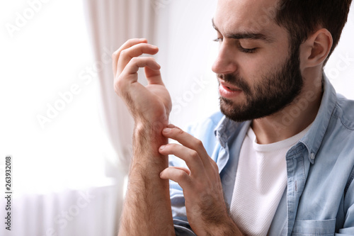 Young man scratching hand indoors, space for text. Allergies symptoms photo