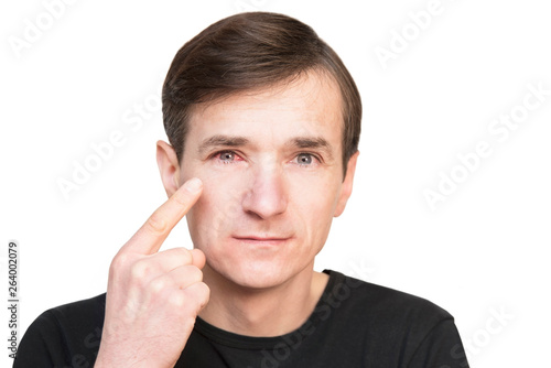 An middle-aged man points his finger to his sick red eye. Man fell ill on conjunctivitis photo