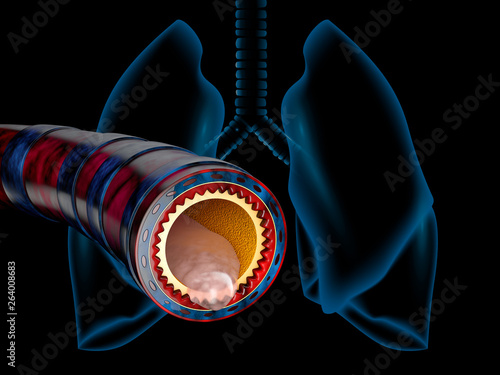 Bronchitis anatomy, mucus secreted as a chest cold as a 3D illustration photo