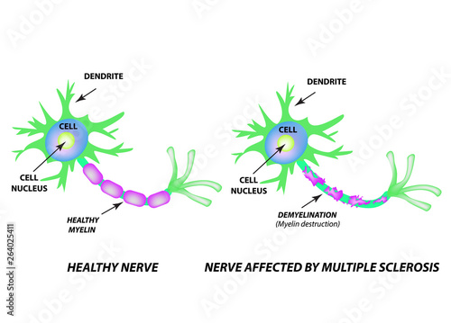 The destruction of the myelin sheath on the axon. Damaged myelin. Neuron affected by multiple sclerosis. World Multiple Sclerosis Day. Infographics. Vector illustration on isolated background.