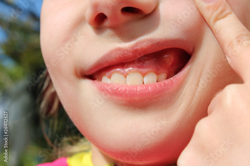 Foto Close up  swelling on gums the child.