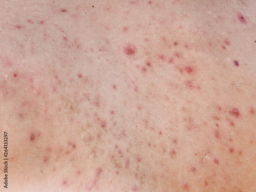 Fototapeta premium Man with acne on his back