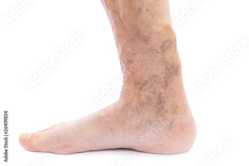 Closeup of foot and leg with varicose © Thunderstock