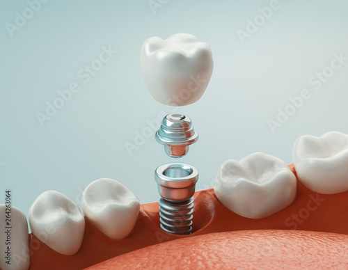 Dental care, dental implant, 3d rendering photo