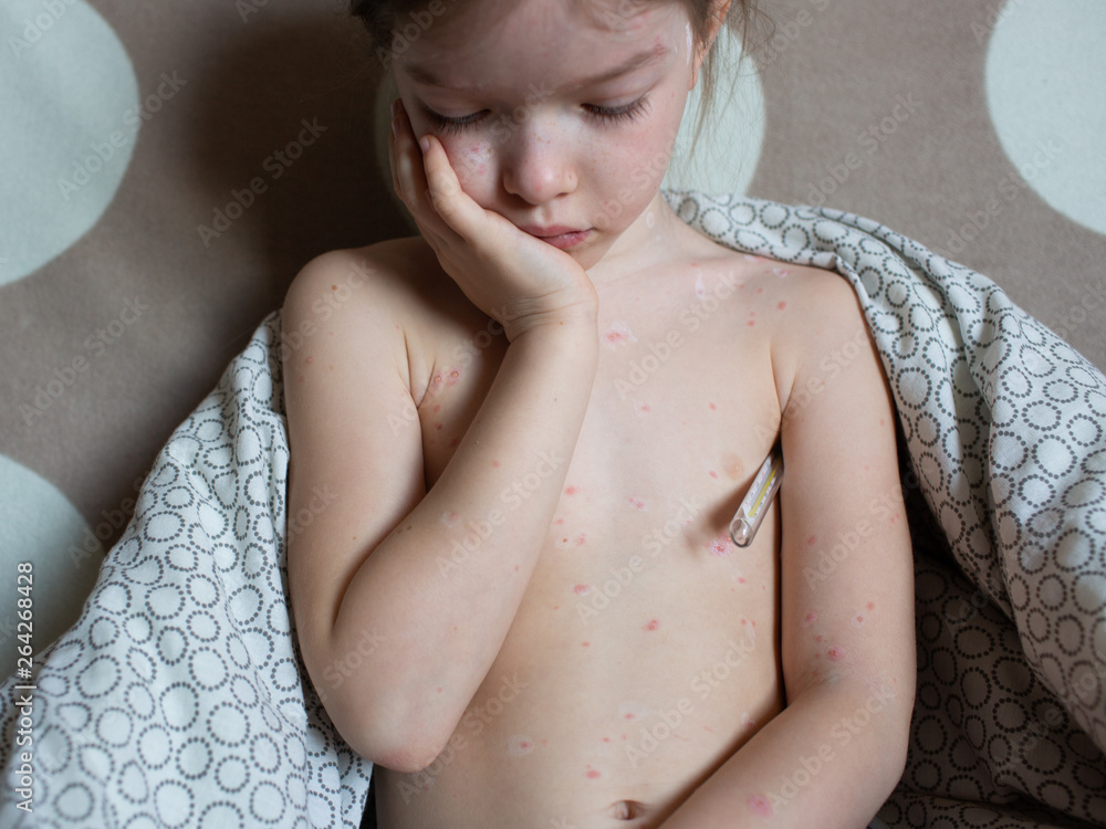 sad girl with chickenpox