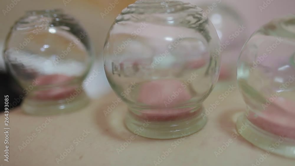 View of Chinese cupping therapy , Tianjin, China View of Chinese cupping therapy , Tianjin, China