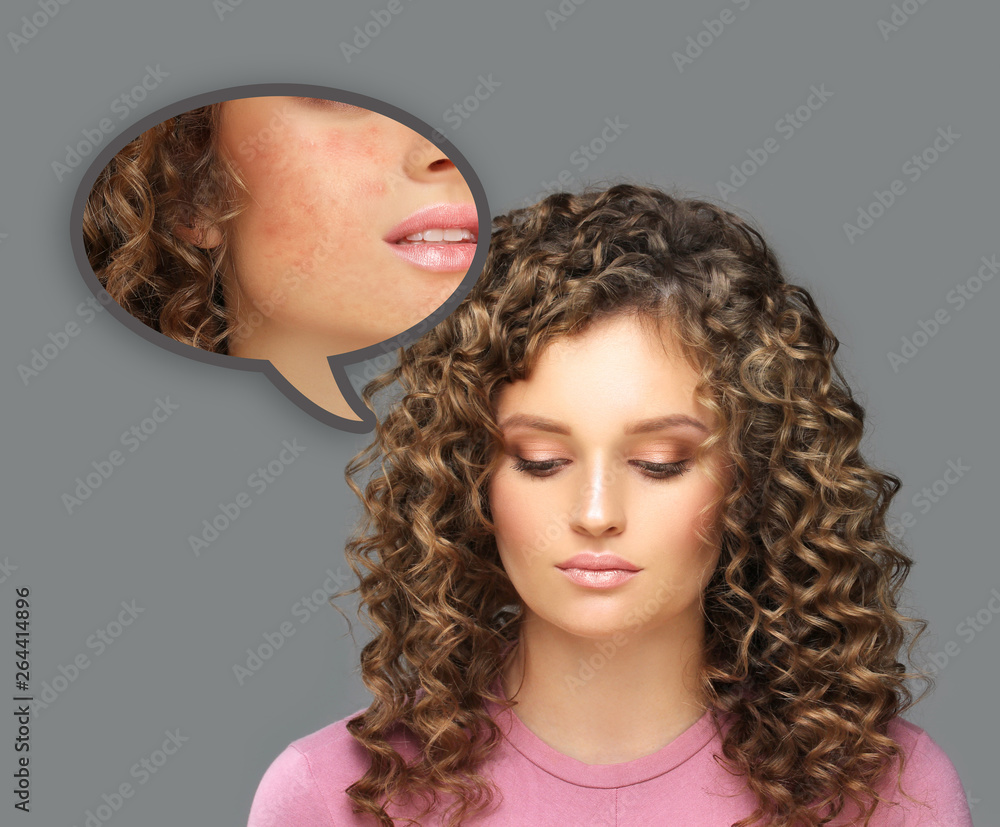 Fototapeta premium Post-Acne Marks /Treating Acne Scars.Acne Scar Removal