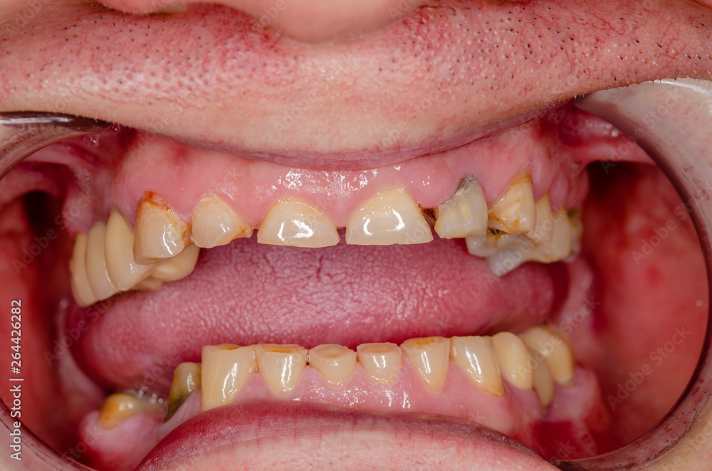 Fototapeta premium intraoral picture of an abraded dentition