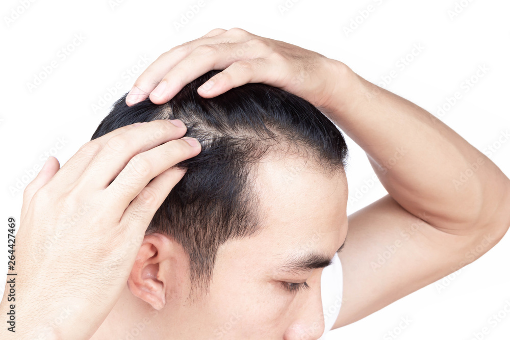 Fototapeta premium Young man serious hair loss problem for health care medical and shampoo product concept