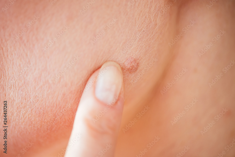 cropped view of woman pointing with finger at mole on skin cropped view of woman pointing with finger at mole on skin