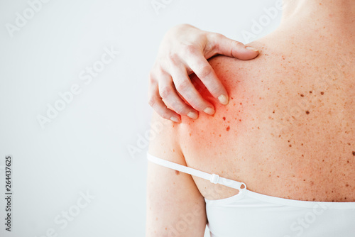 cropped view of sick woman with allergy scratching red skin on hand isolated on white