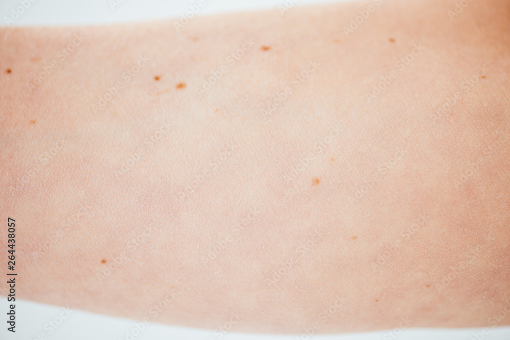 cropped view of woman with birthmarks on white cropped view of woman with birthmarks on white