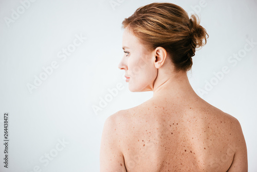 attractive and naked woman with skin sickness on white