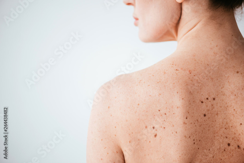 cropped view of naked woman with skin sickness on white