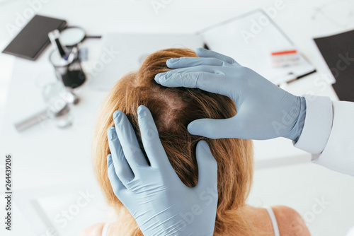 overhead view of dermatologist in blue latex gloves examining hair of patient in clinic photo