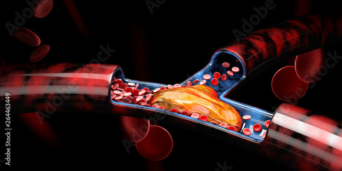 3d Illustration of Deep Vein Thrombosis or Blood Clots, Embolism.