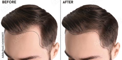 Young man before and after hair loss treatment against white background, closeup