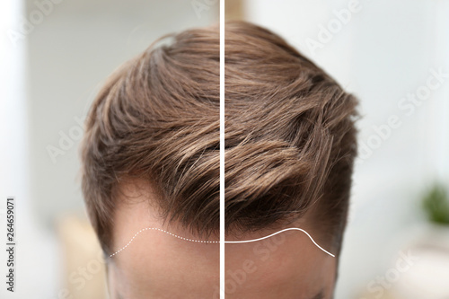 Young man before and after hair loss treatment against blurred background, closeup