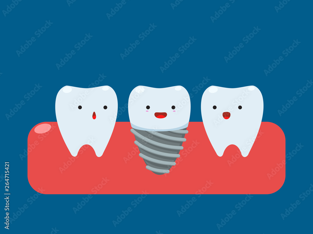 The implant tooth between other. Isolated Vector Illustration The implant tooth between other. Isolated Vector Illustration