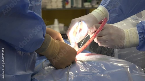 Minimally invasive spine surgery, also known as MISS, has no specific meaning or definition. Basically, it is marketing language that implies a lack of severe invasion, that may or may not be the case