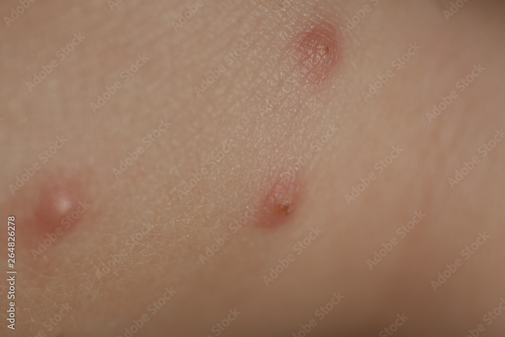 Fototapeta premium ukąszenia owadów na skórze dziecka