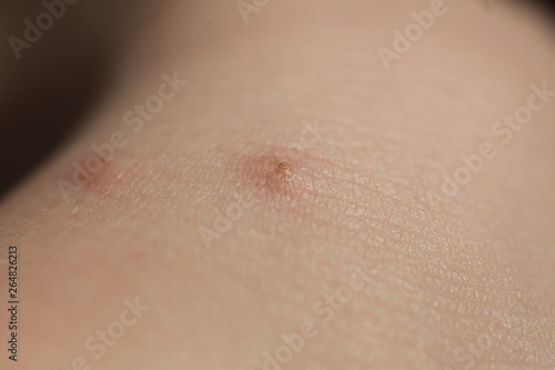 insect bites on skin child