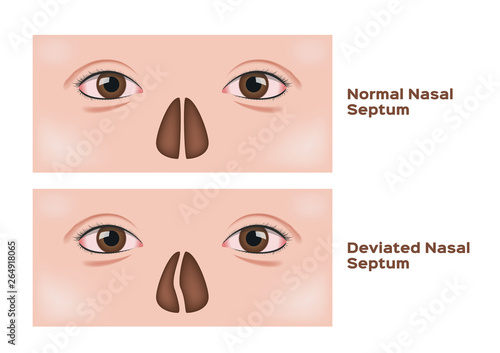 deviated nasal septum vector / human nose