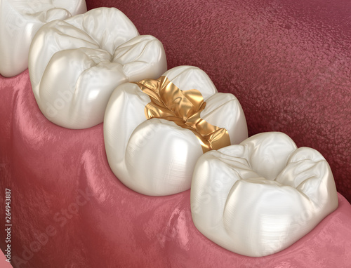 Foto Golden Inlay crown fixation over tooth