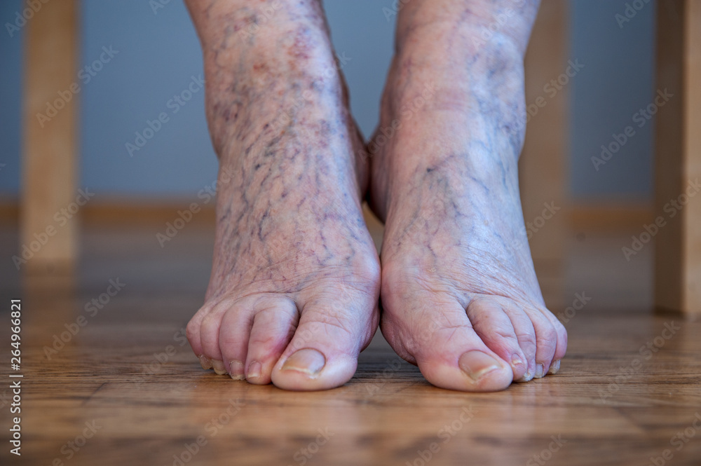 elderly woman with sore legs is sitting on chair and preparing for