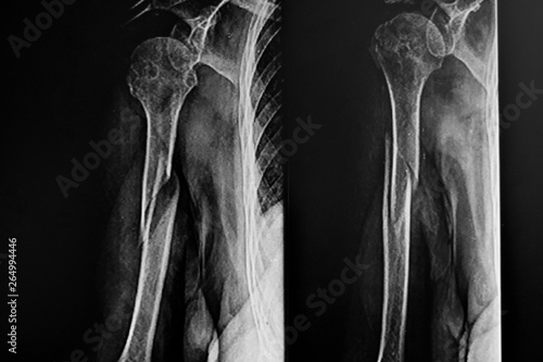 X- Ray of Right humerus bone fracture