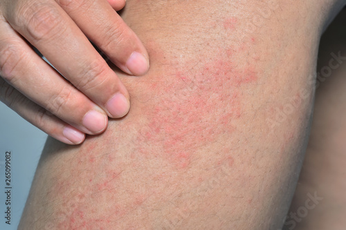 Принти на полотні Red allergic rash on the leg skin from Atopic dermatitis