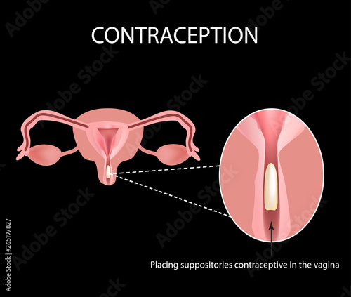 Contraceptives suppositories. Infographics. Vector illustration on a black background.