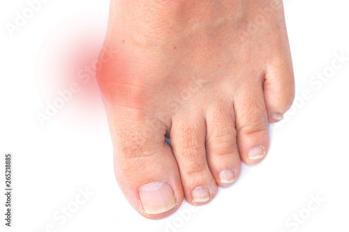 Foot of a woman with painful Hallux Valgus © lavizzara