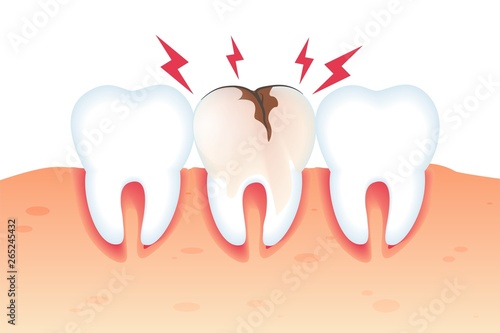 Pain in Broken Tooth Illustration Realistic 3d. 
