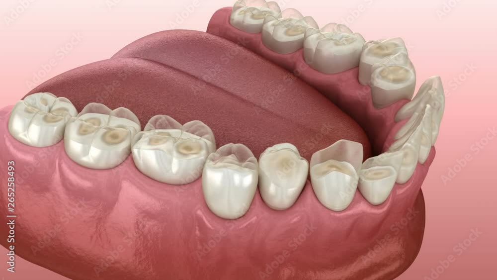 Dental attrition (Bruxism) resulting in loss of tooth tissue. Medically accurate tooth 3D animation Dental attrition (Bruxism) resulting in loss of tooth tissue. Medically accurate tooth 3D animation