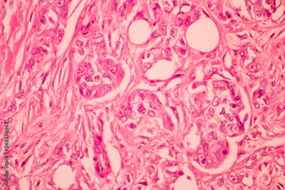 View in microscopic of pathology section ductal cell carcinoma or adenocarcinoma diagnosis by pathologist in laboratory.Criteria of breast cancer.Medical concept.