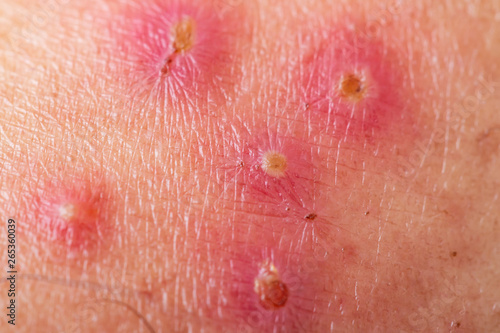 Wound infection on the skin, Skin lesions, Impetigo, Ecthyma, Pressure