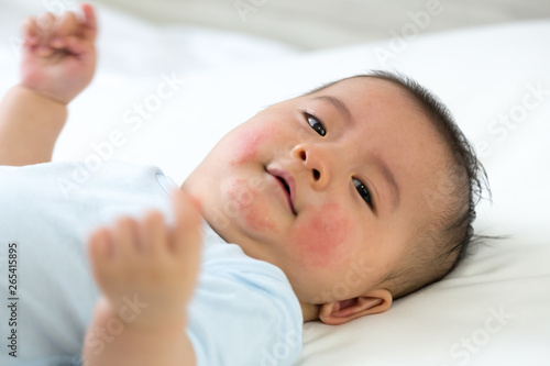 Baby has an allergic reaction to the face, Skin rashes in babies concept
