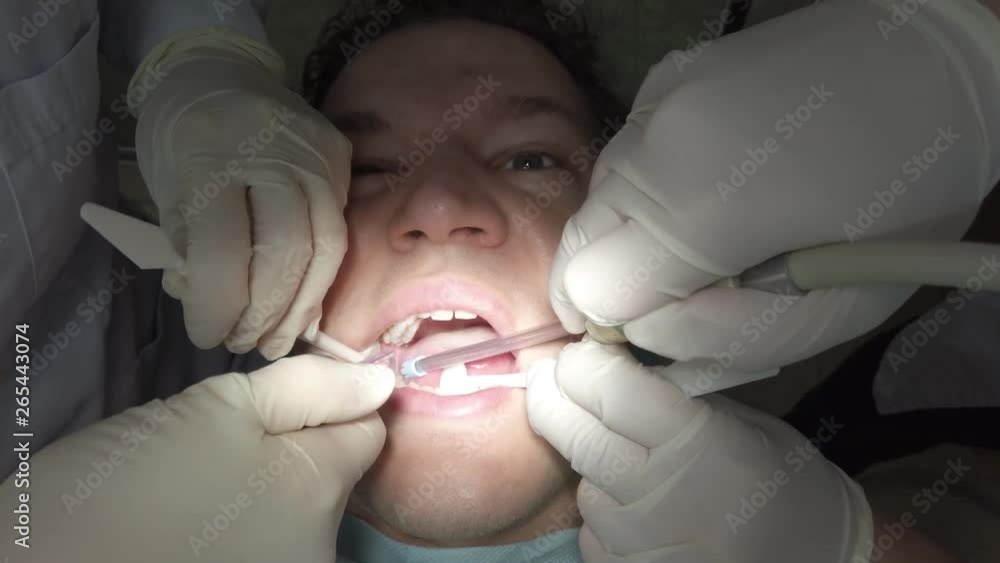 Man gets painful root canal. Closeup of dentist and assistant performing operation on patient's teeth. Inside the mouth of dental surgery. Lying on chair for checkup at dentists office. Man gets painful root canal. Closeup of dentist and assistant performing operation on patient's teeth. Inside the mouth of dental surgery. Lying on chair for checkup at dentists office.