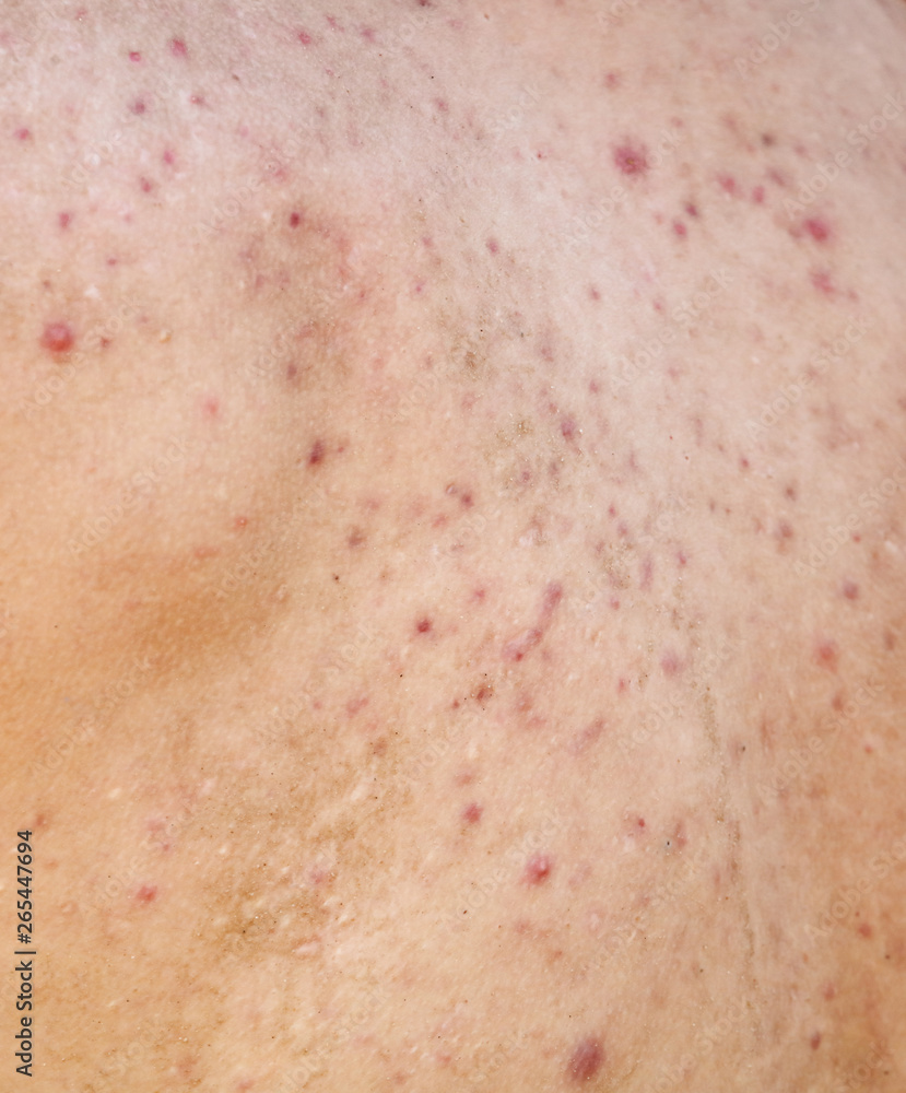 Man with acne on his back