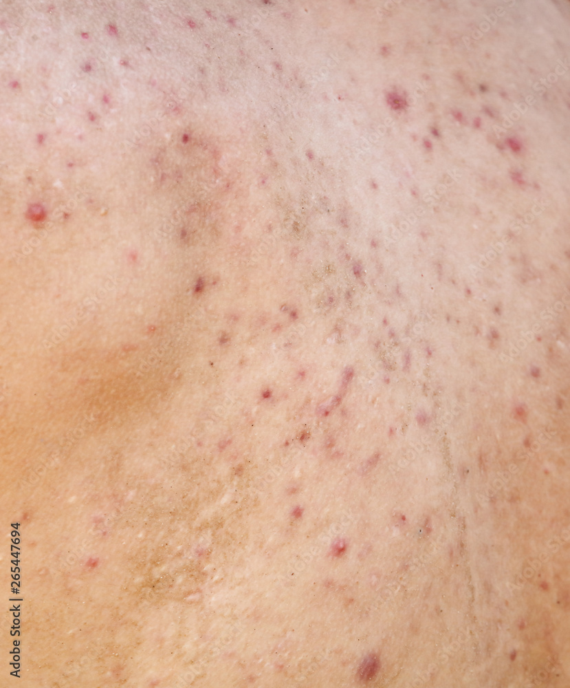 Man with acne on his back Man with acne on his back