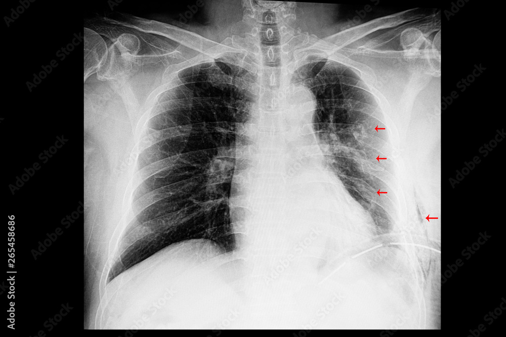 Chest X Ray Showing Rib Fractures Subcutaneous Emphysema And My Xxx