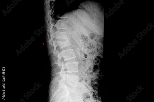 Fotografie xray film of a patient showing compression fracture of lambar spine