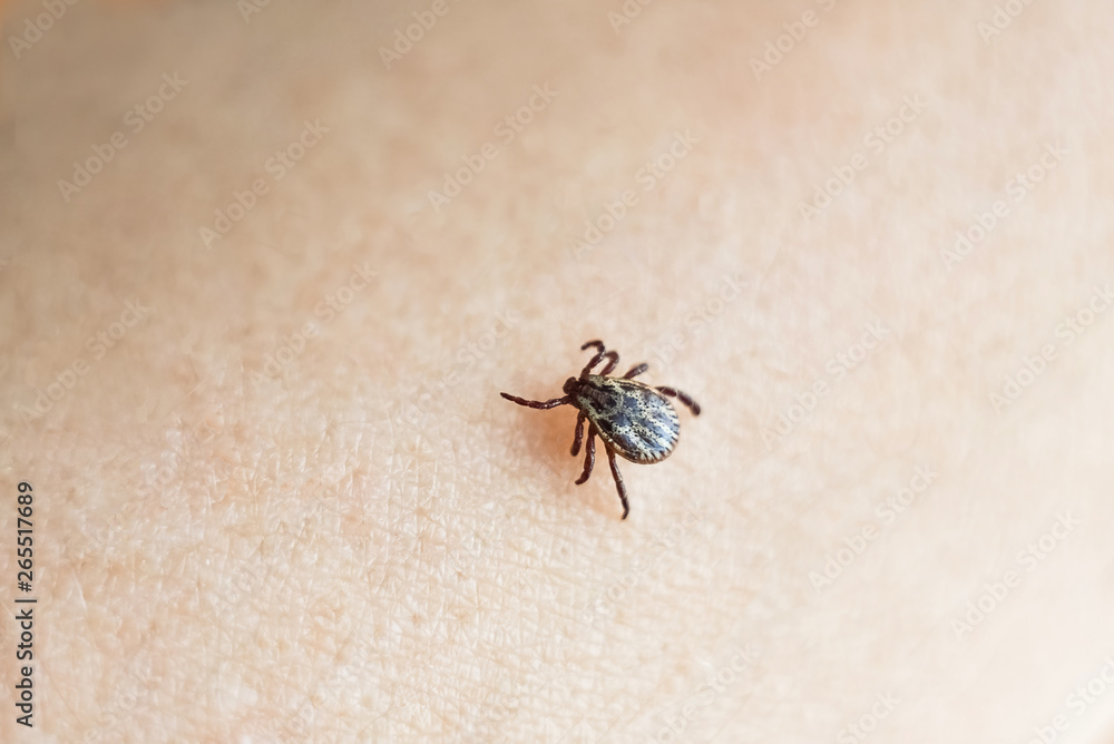The parasite mite sits on a person’s skin. infection carrier. Ixodes ricinus The parasite mite sits on a person’s skin. infection carrier. Ixodes ricinus