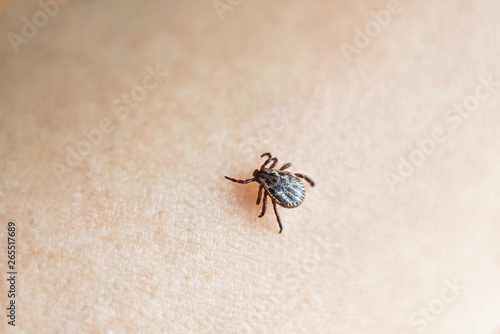 The parasite mite sits on a person’s skin. infection carrier. Ixodes ricinus