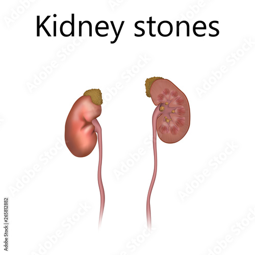 Kidney stones. Urolithiasis, renal lithiasis, nephrolithiasis, clumps of mineral. Realistic anatomy vector illustration.