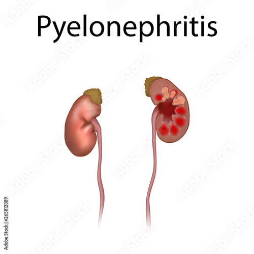 Pyelonephritis. Kidney infection. Infected. Realistic anatomy vector illustration.