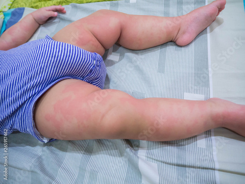 Baby with symptoms of itchy urticaria at legs. Red blister and rash, allergic reactions.