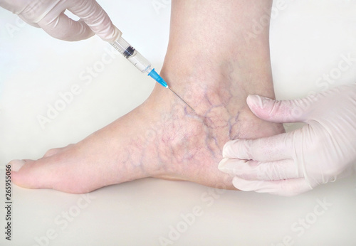 Spider veins on the womans legs, sclerotherapy treatment photo