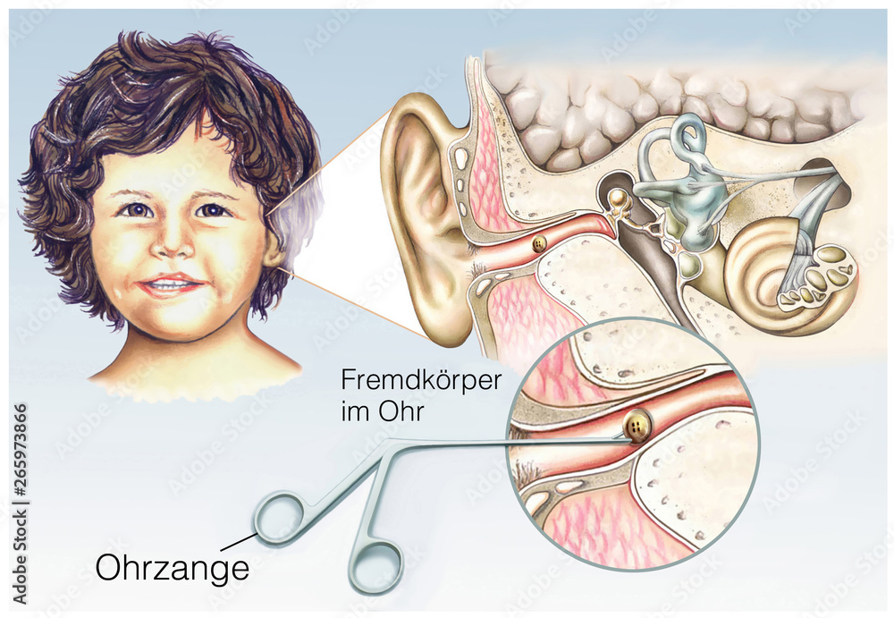 Fremdkörper im Ohr bei Kindern – Stock-Illustration | Adobe Stock